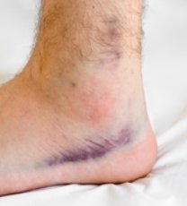 ankle bruise